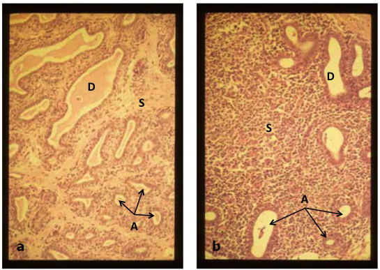 Figure 3a. Portion of mammary parenchymal
tissue typical of that obtained from uninfected
quarters exhibiting small milk-producing alveoli
(A) with ovoid lumens and large ducts (D) containing
secretions, and interalveolar connective
tissue stroma (S). x180.
Figure 3b. Parenchymal tissue from a quarter
infected with Staph. aureus exhibiting fewer
numbers of alveoli (A) and ducts (D) with empty
lumens, and a larger percentage of interalveolar
connective tissue stroma (S) containing many
leukocytes. x180.